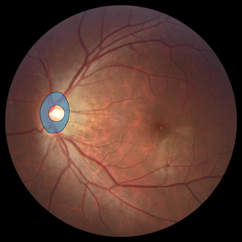 Optic Disc in Retinal Fundus