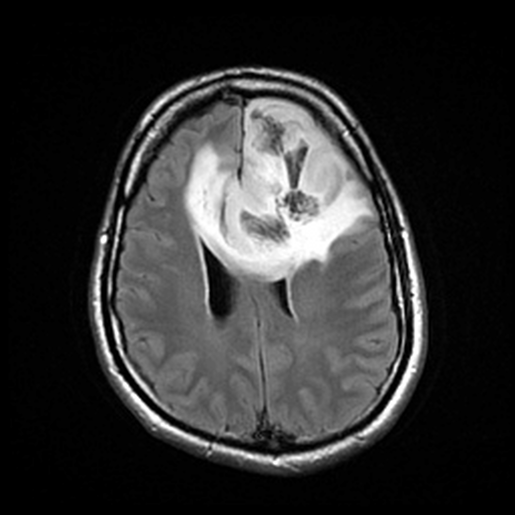 Brain MRI-FLAIR