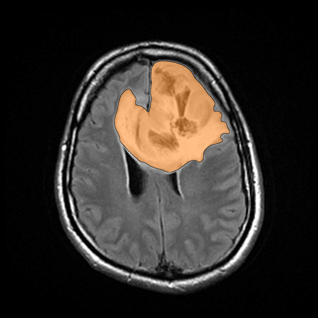 Lower-Grade Glioma in Brain MRI-FLAIR