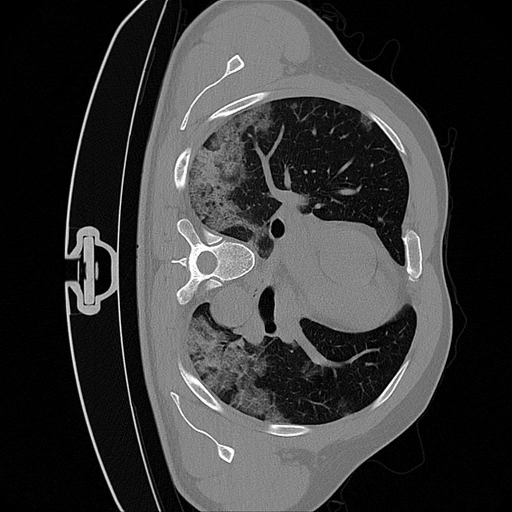 CT Lung