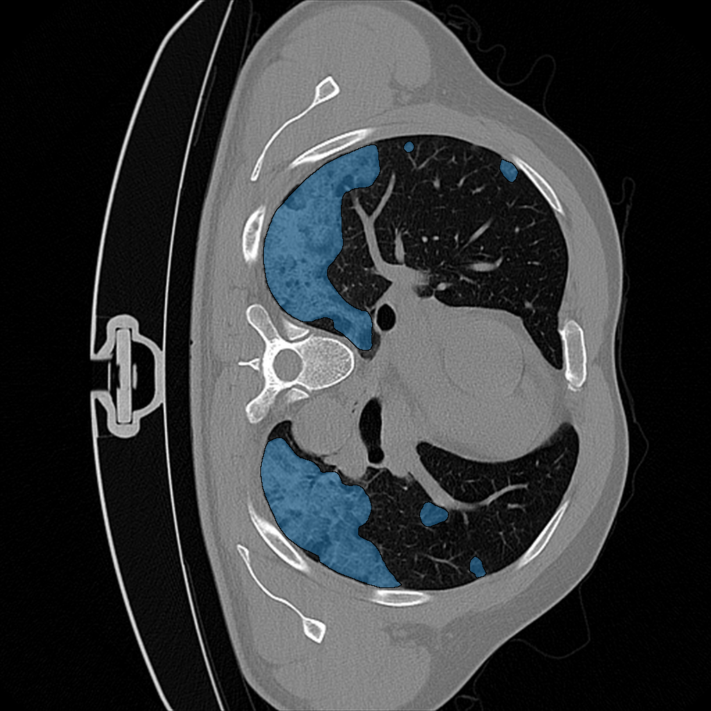 COVID-19 Infection in Lung CT