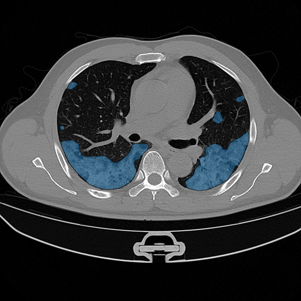 COVID-19 Infection in Lung CT