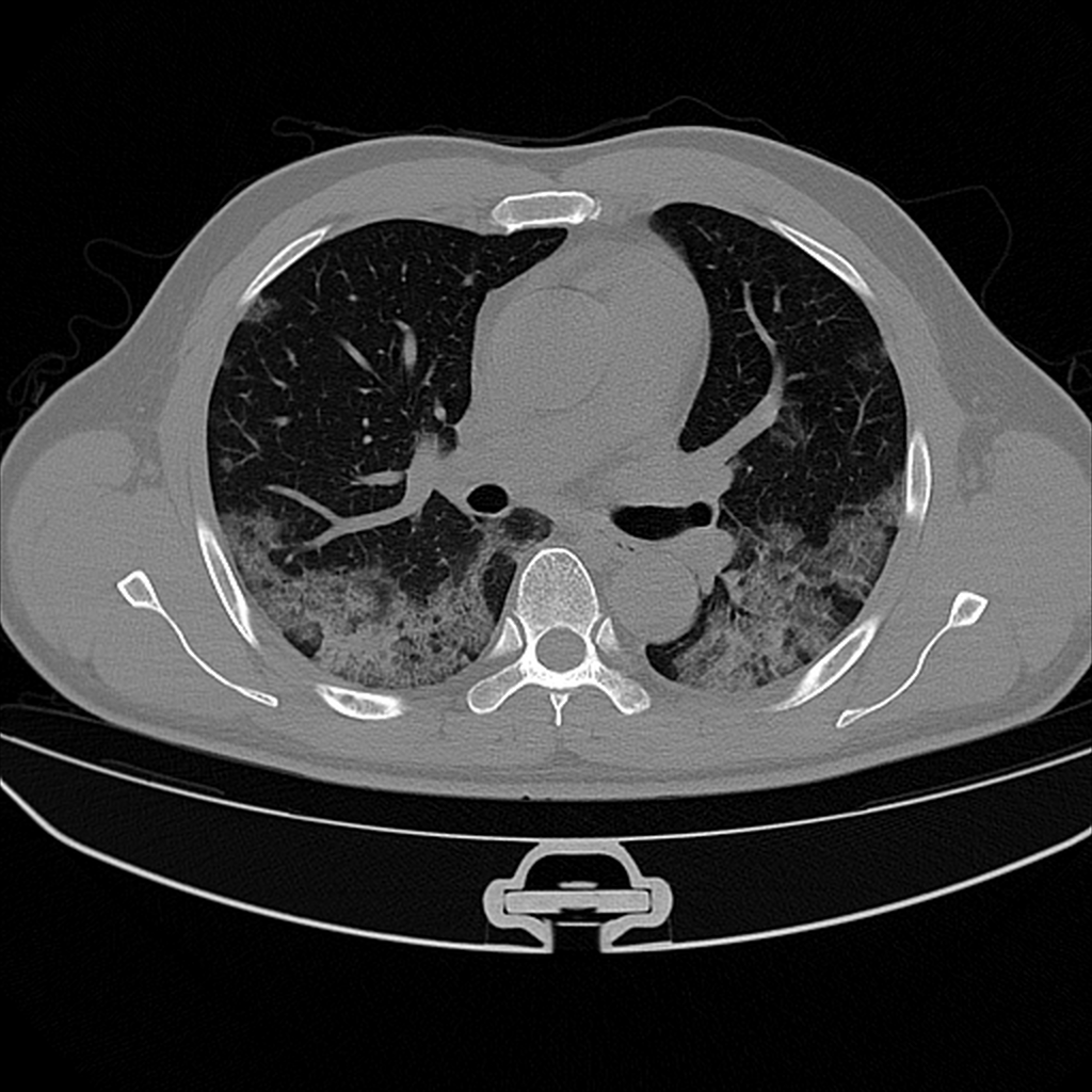 CT Lung