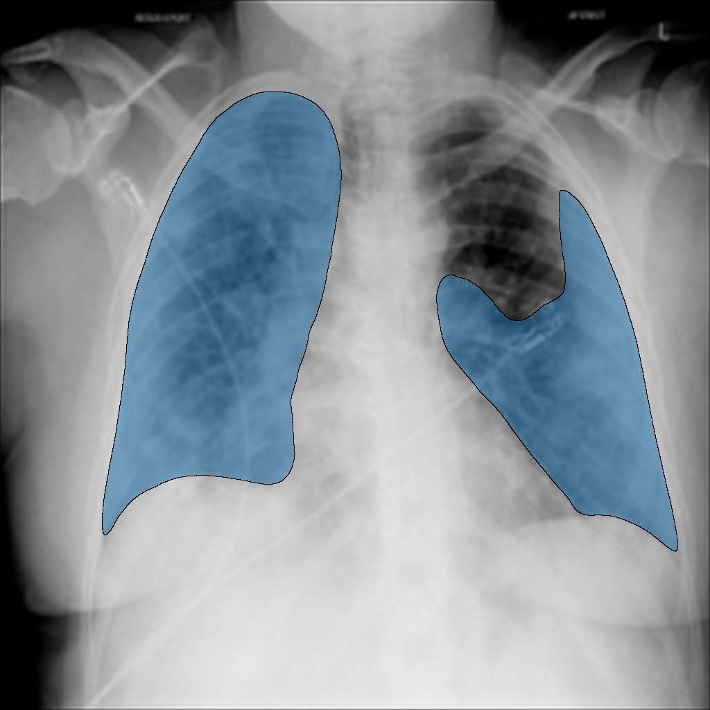 COVID-19 Infection in Chest X-Ray