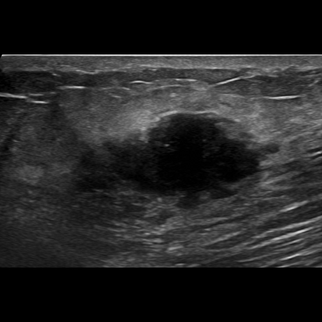 Ultrasound Breast