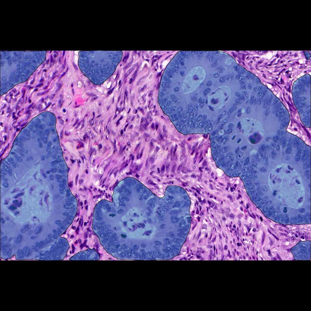 Glandular Structure in Colon Pathology